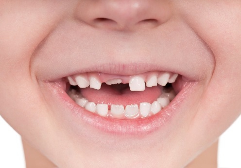 Những vấn đề liên quan đến răng sữa của trẻ cần được phụ huynh lưu ý?