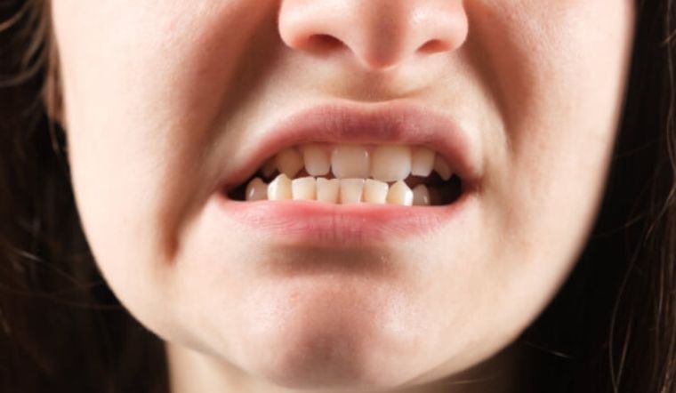 Răng vĩnh viễn mọc lệch vào trong: Nguyên nhân và dấu hiệu nhận biết 2