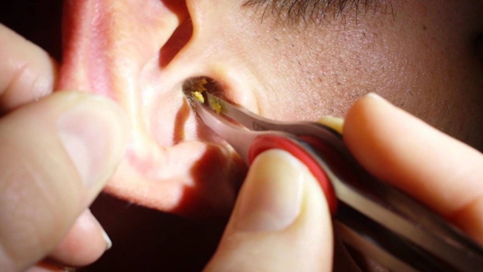 Làm sao để ngăn ngừa và giảm thiểu sự hình thành của ráy tai trong tai?
