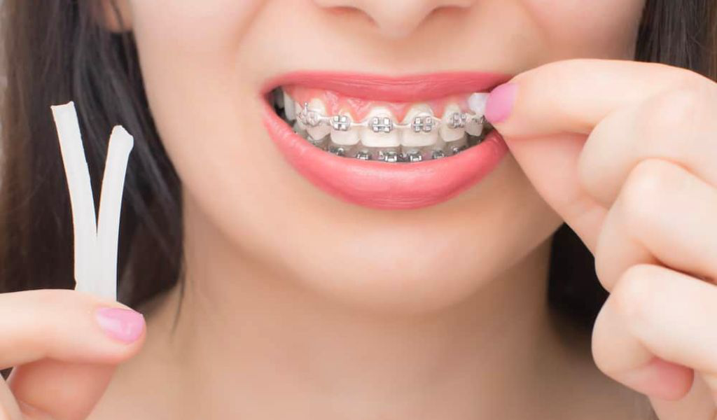 Có những trường hợp nào cần hỏi ý kiến bác sĩ trước khi sử dụng sáp niềng răng?