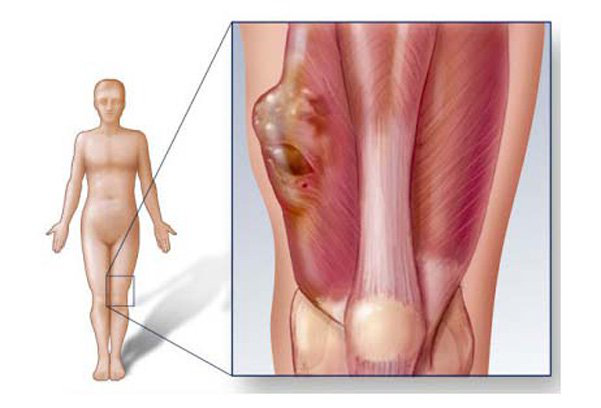 Sarcoma mô mềm sống được bao lâu? 2