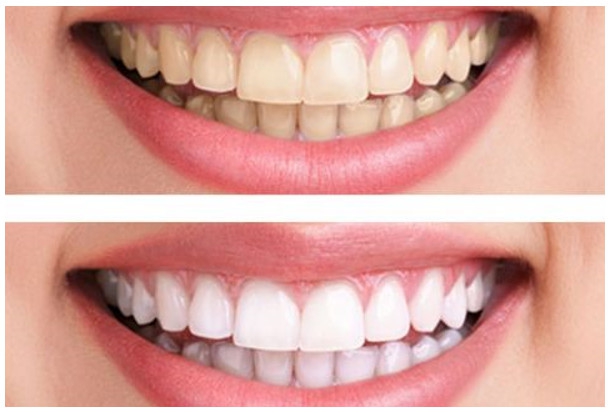 Lý do vì sao răng trở nên nhạy cảm sau khi cạo vôi răng?
