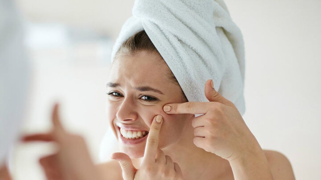 Sau khi nặn mụn đầu đen nên làm gì? Một số thông tin bạn cần biết về mụn đầu đen