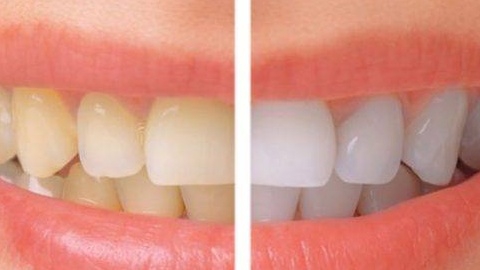 Quá trình tẩy trắng răng có gây đau nhức không? 
