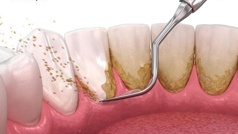 Sau sinh bao lâu thì được lấy cao răng? 2