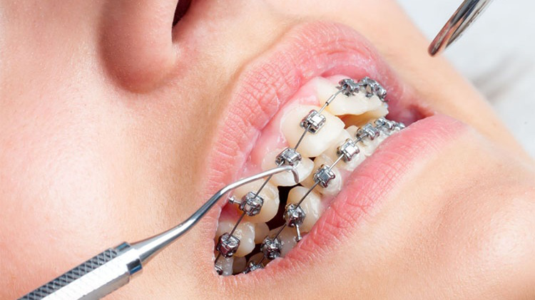 Làm thế nào ngậm nước lạnh có thể giảm đau khi siết răng?
