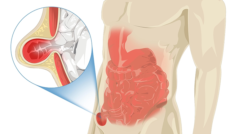 Cách thực hiện và chẩn đoán siêu âm thoát vị bẹn  1