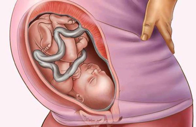 Sinh mổ là gì? Những điều cần biết về quá trình mổ lấy thai 3