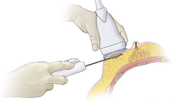 Sinh thiết hút chân không là gì? Kỹ thuật này áp dụng cho ai? 1