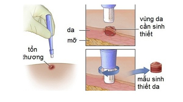 Ung thư hắc tố da là gì? Sinh thiết nốt ruồi và phân biệt nốt ruồi ác tính 2