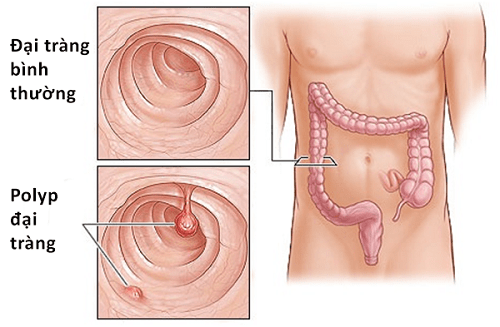 Kết quả sinh thiết polyp đại tràng ác tính khi nào?  3