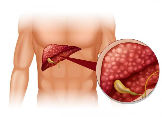 Những người không nên ăn quả bơ nên chú ý  3