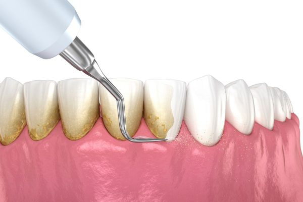 Bựa răng: Nguyên nhân và tác hại ảnh hưởng đến sức khỏe răng miệng 1