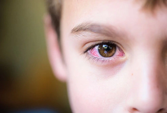 Đau mắt đỏ không nên ăn gì? Những thực phẩm cần lưu ý khi đau mắt đỏ 1