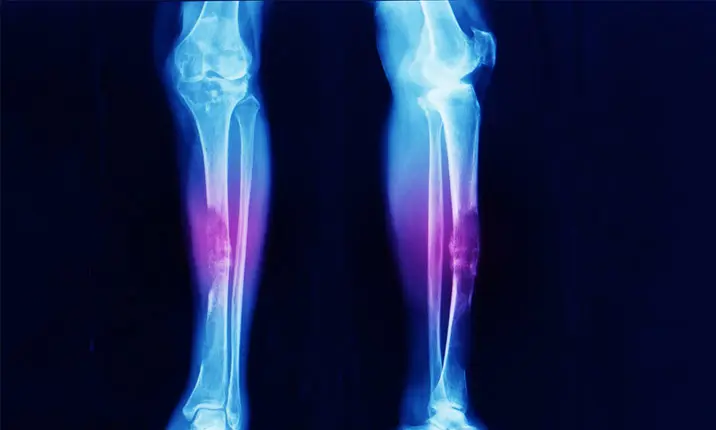 Điều trị Sarcoma mô mềm ở tay chân 1