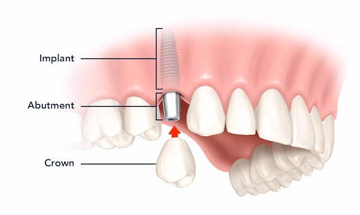 Tại sao phương pháp trồng răng Implant Tekka được ưa chuộng hiện nay? 2