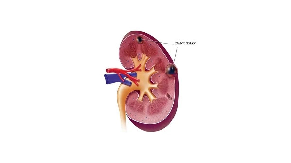 Phân biệt thận đa nang và nang thận 1