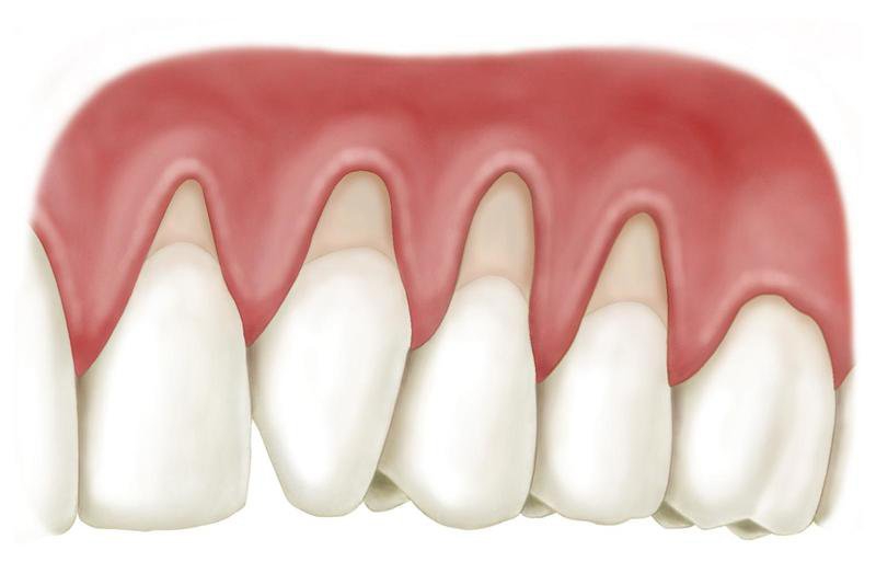 Nguyên nhân gây tụt lợi chân răng là gì?
