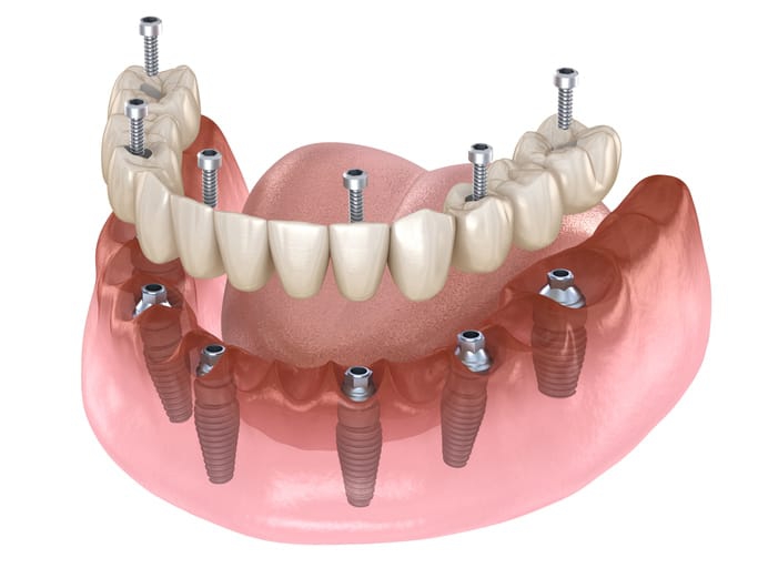 Phương pháp trồng răng Implant all on 6 có ưu điểm gì? 4
