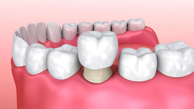 Mài răng bọc sứ, răng thật có bị yếu đi không?