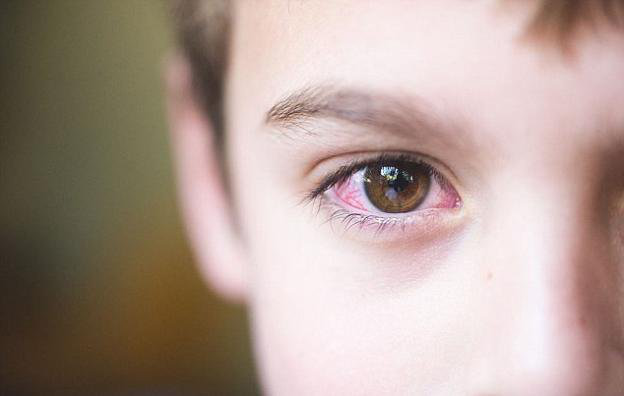Trẻ em 2 tuổi bị nháy mắt liên tục: nguyên nhân và cách khắc phục 3