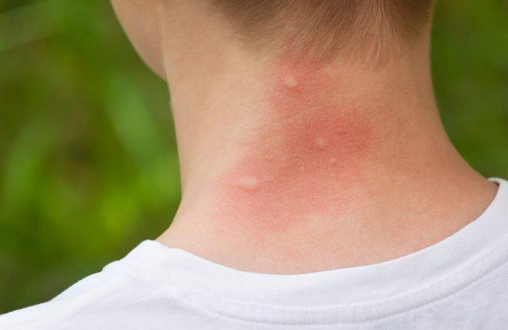 Vết côn trùng cắn nguy hiểm như thế nào? Cách xử lý như thế nào?