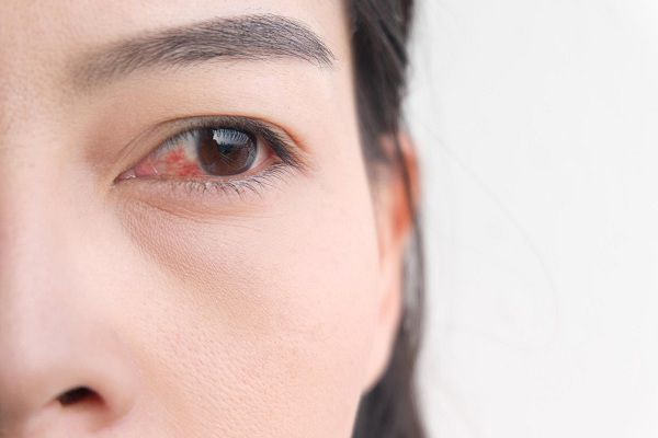 Viêm kết mạc có lây không? Cách ngăn chặn lây lan hiệu quả