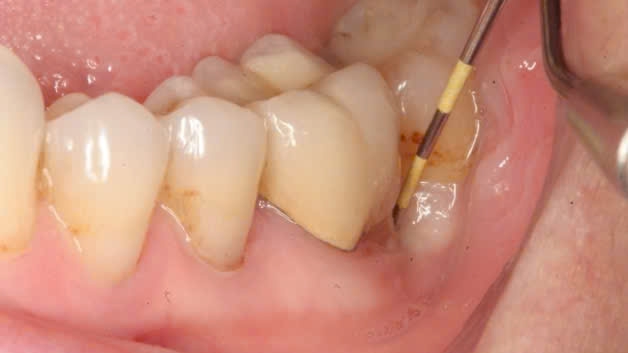 Viêm quanh thân răng cấp: Nguyên nhân, triệu chứng và cách điều trị 1