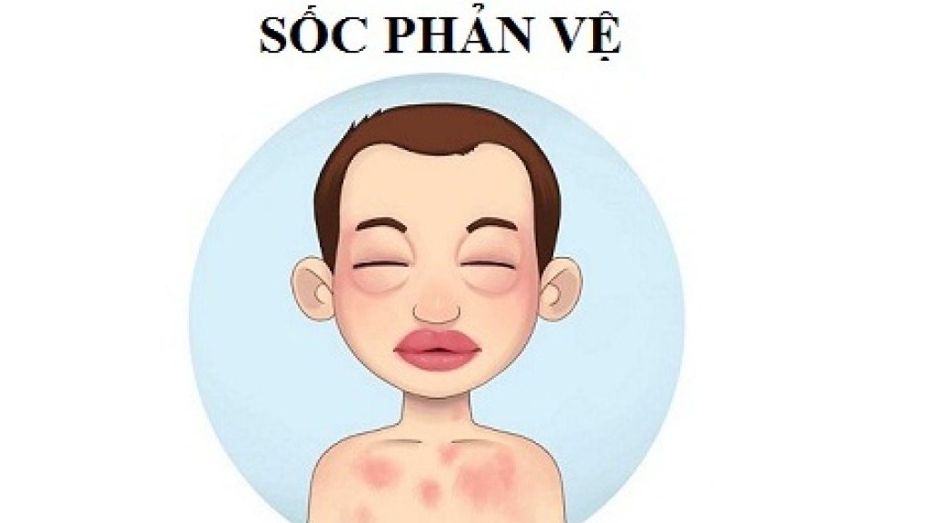 Sơ cứu sốc phản vệ đúng cách và hiệu quả