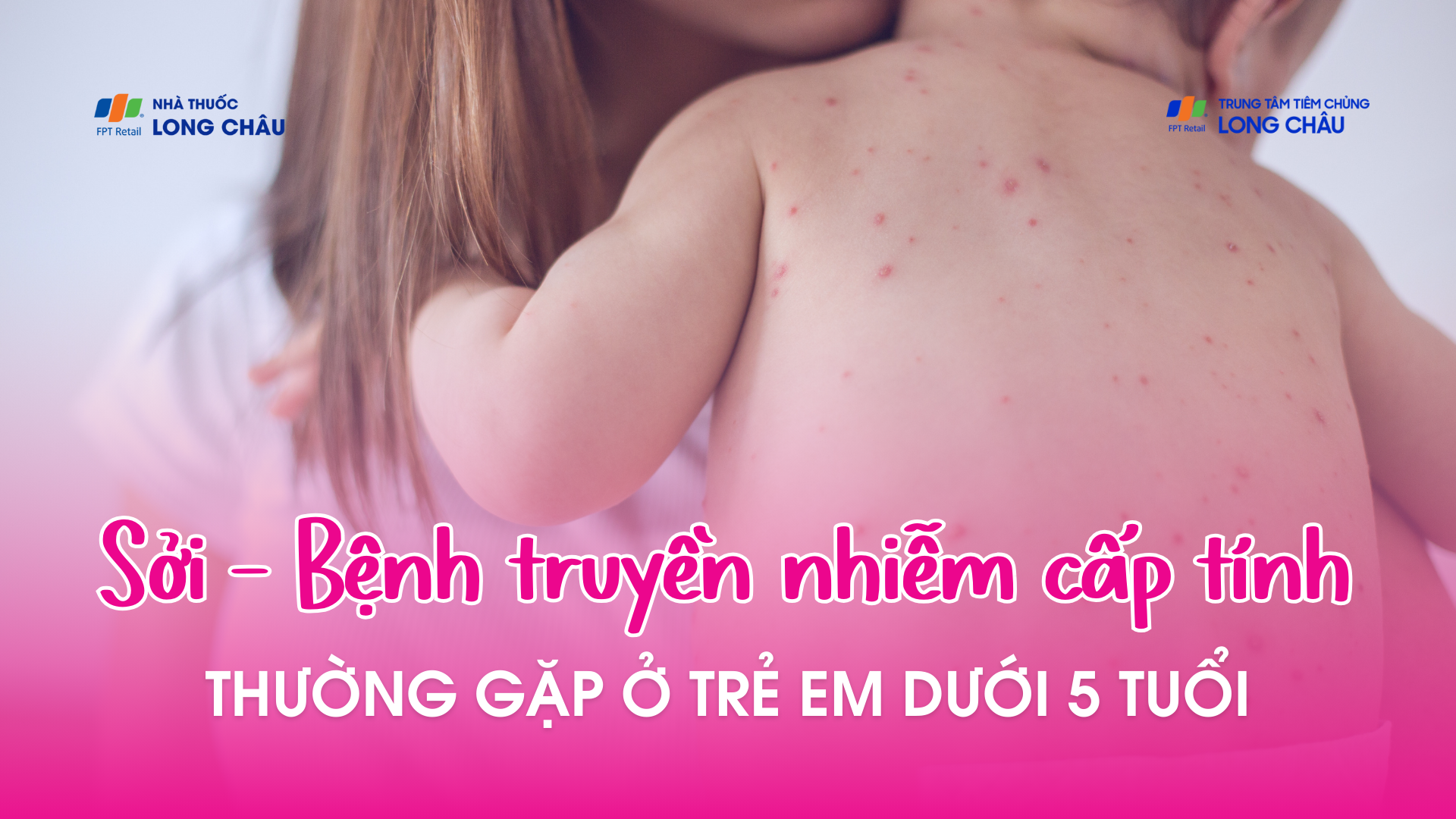 Sởi - Bệnh truyền nhiễm cấp tính thường gặp ở trẻ em dưới 5 tuổi