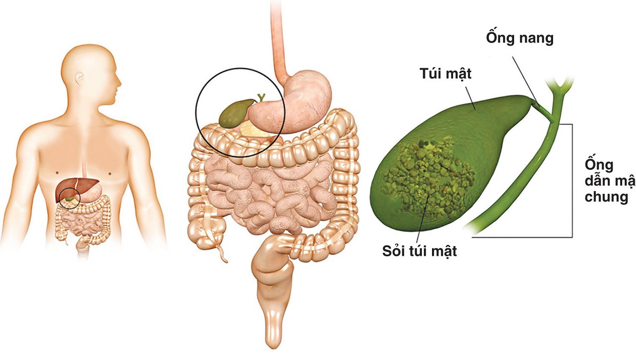 Sỏi túi mật 8mm có nguy hiểm không? Triệu chứng và cách phòng ngừa