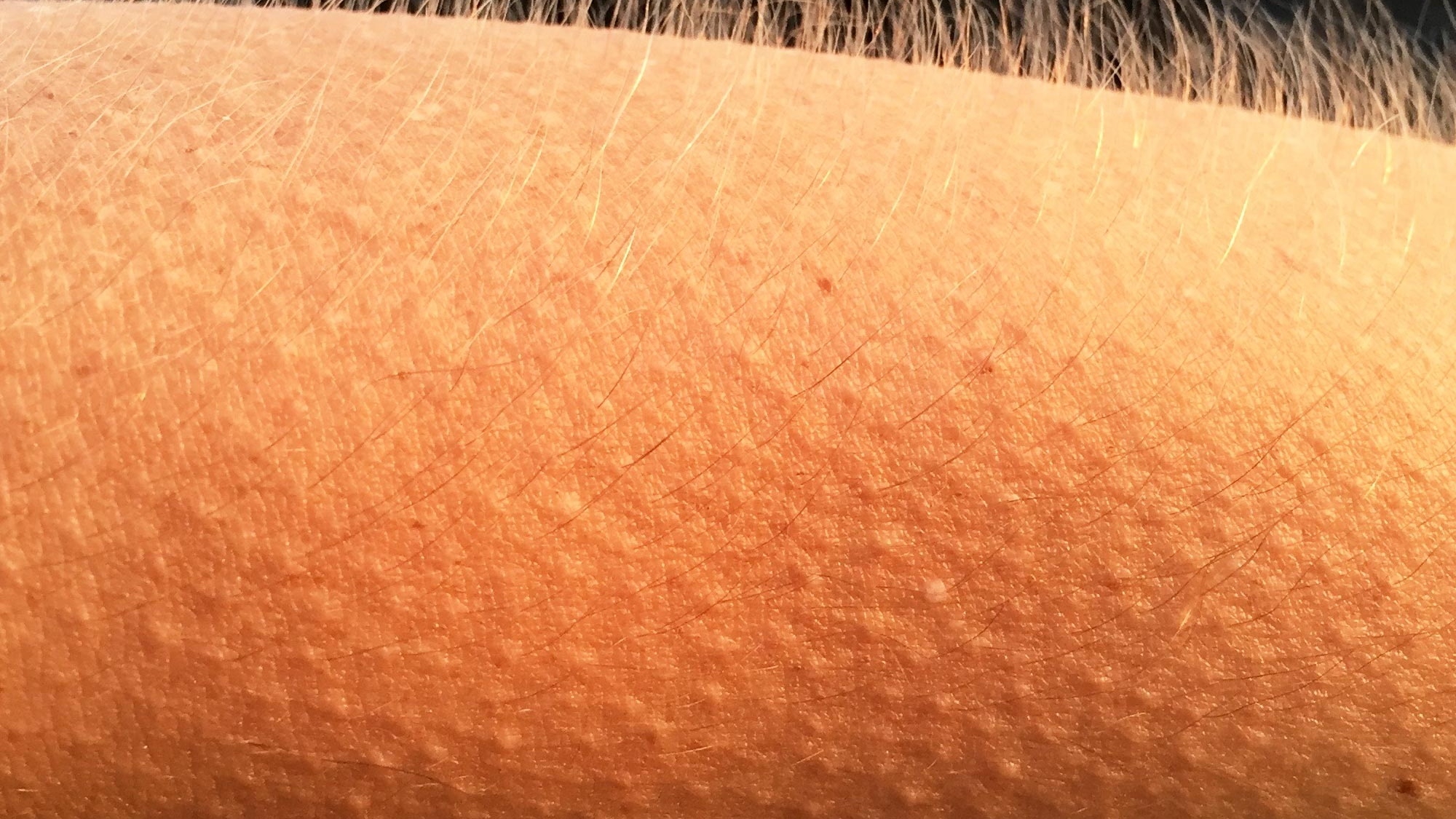 Sởn gai ốc là gì? Những nguyên nhân khiến bạn bị sởn gai ốc