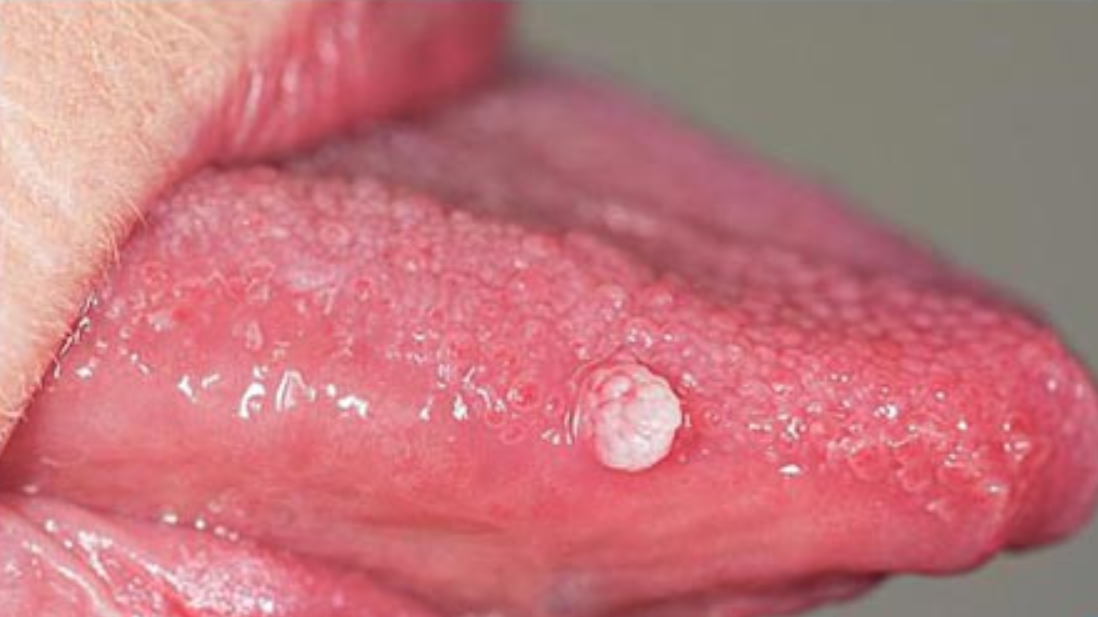 Lưỡi bình thường và lưỡi bị bệnh khác gì nhau  Vinmec