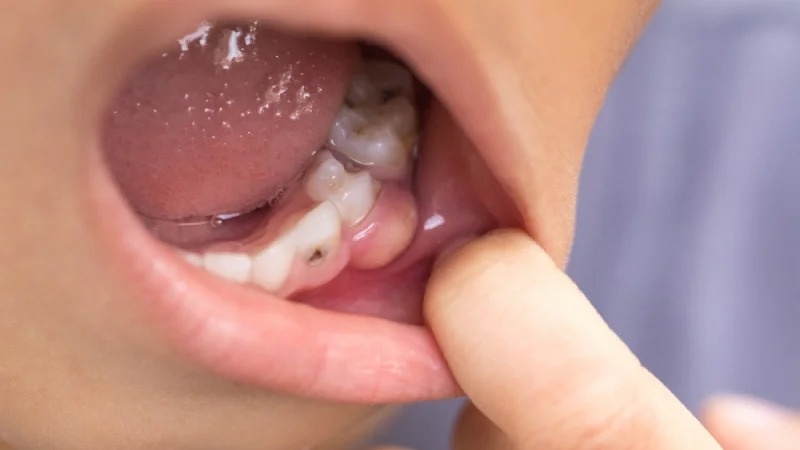 Sưng mộng răng là gì? Dấu hiệu nhận biết sưng mộng răng?