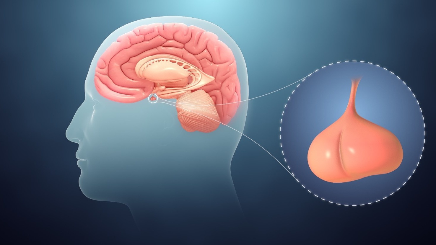 Suy tuyến yên có nguy hiểm không? Điều trị như thế nào?