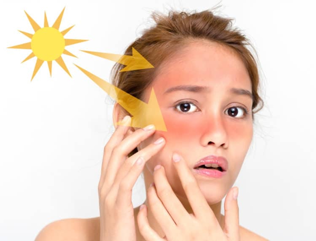 Tác hại của thói quen không dùng kem chống nắng - Nhà thuốc FPT Long Châu