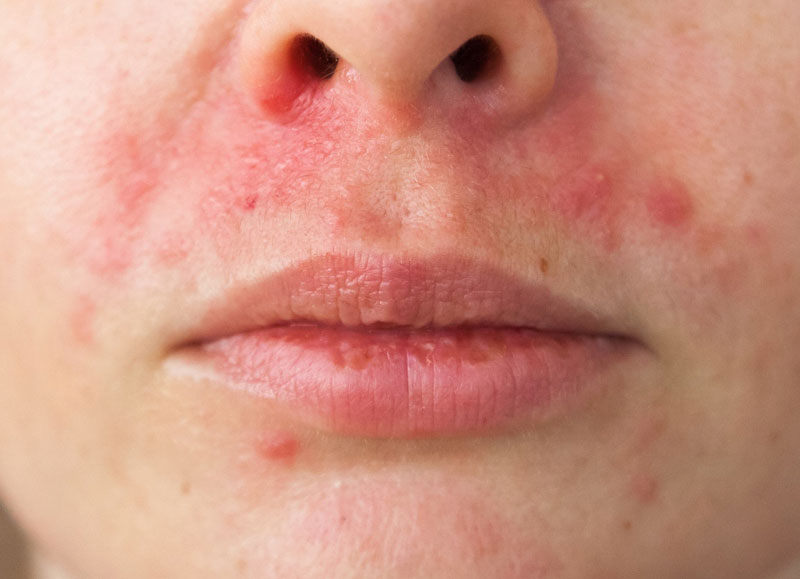 Tác hại của việc bôi kem đánh răng lên mặt: Đọc ngay để phòng tránh! 3