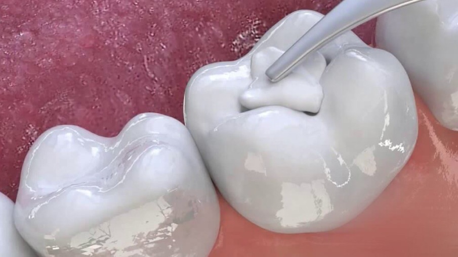Tác hại của việc trám răng thưa có thể làm suy yếu chức năng nào khác của miệng?
