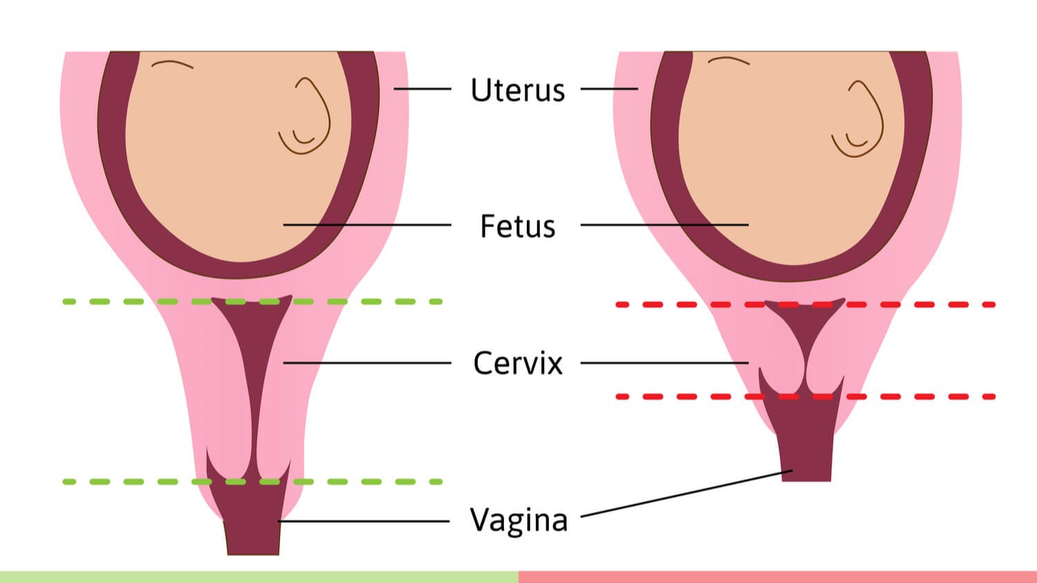 Tại sao cổ tử cung mở chậm? Nguyên nhân và cách phòng ngừa