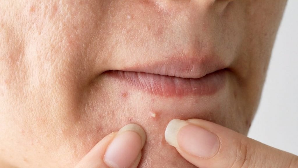 Thiếu vitamin gì có thể gây ra mụn ở mũi có mùi hôi?
