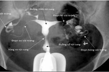 Tại sao phải chụp X quang tử cung vòi trứng? Có cần thiết không? 2