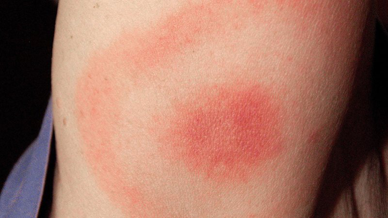 Tại sao sau khi tiêm phòng bị đau tay và cách xử trí 1