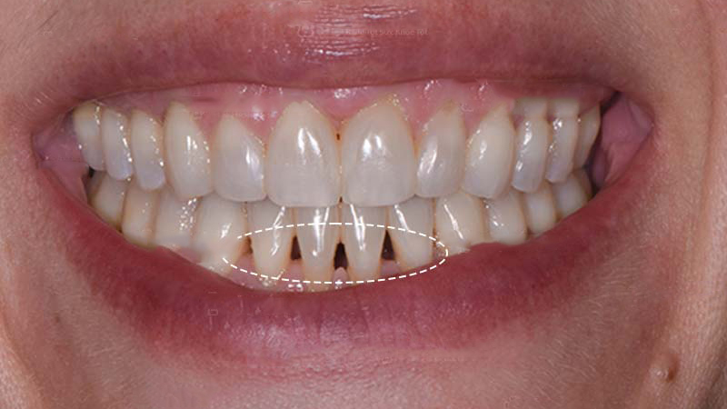 Tam giác nướu sau niềng răng: Nguyên nhân và cách khắc phục 1