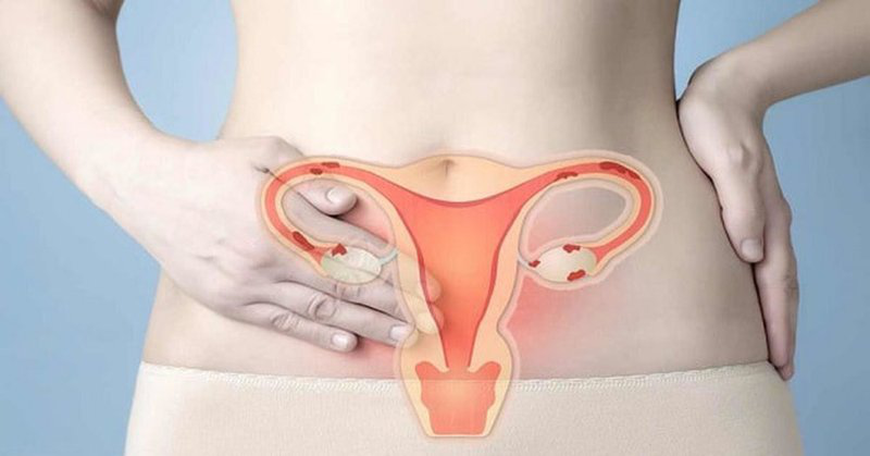 Nguyên nhân gây tăng sinh nội mạc tử cung bạn nên biết 2