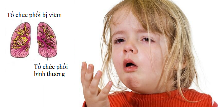 Tất tần tật những điều cần biết về bệnh viêm phổi ở trẻ em 2