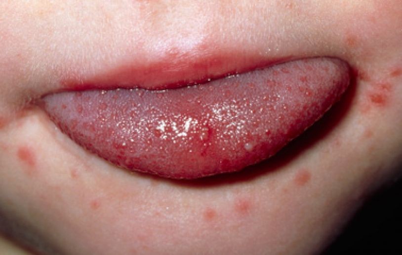 Tay chân miệng trẻ em và những sai lầm mẹ cần tránh khi chăm sóc