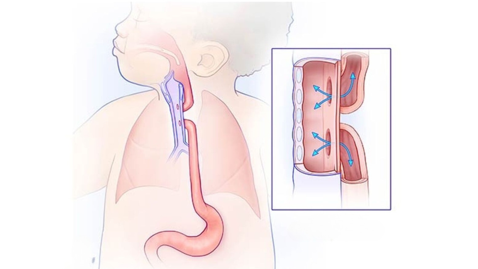 Teo thực quản bẩm sinh: Nguyên nhân, triệu chứng và cách điều trị