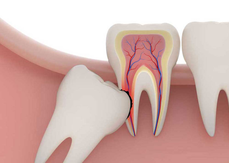 Thắc mắc: Mọc răng khôn đau mấy ngày?  4