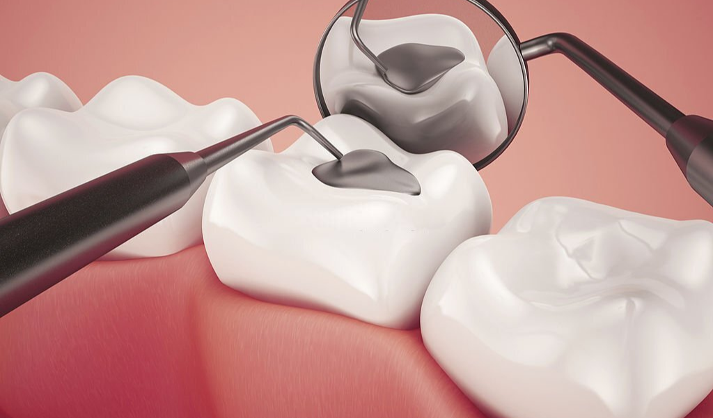 Sau khi trám răng nên làm gì ? Mẹo và lời khuyên sau trám răng