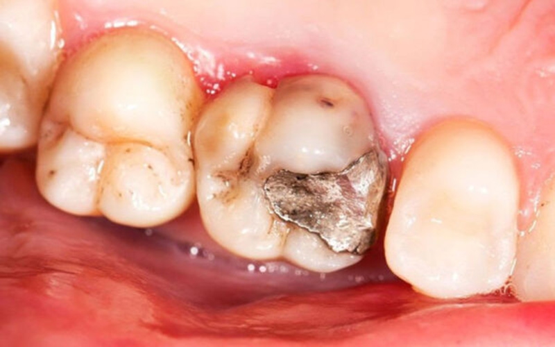 Thế nào là trám răng bằng amalgam? Liệu có an toàn không?